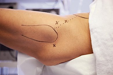Foto: Knie mit Markierungen für eine anstehende Operation.