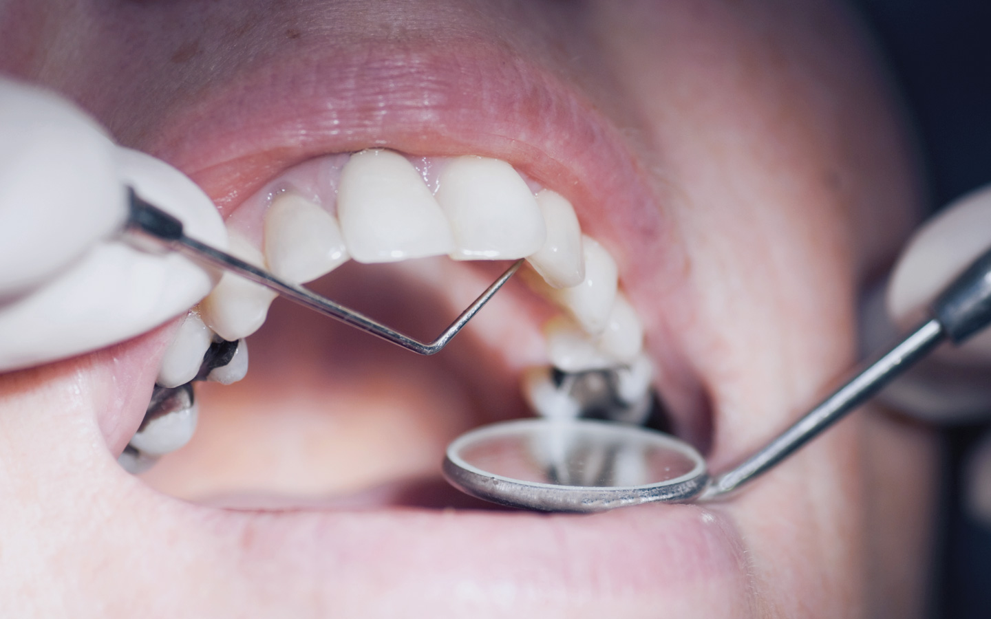 Foto: Ein geöffneter Mund, in dem Zähne mit verschiedenen Füllungen zu sehen sind, die mit Zahnarztbesteck untersucht werden.