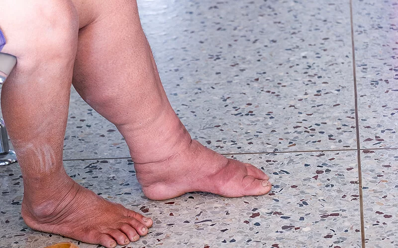 Geschwollene Beine einer Frau, die nackten Füße auf einem Steinfußboden.