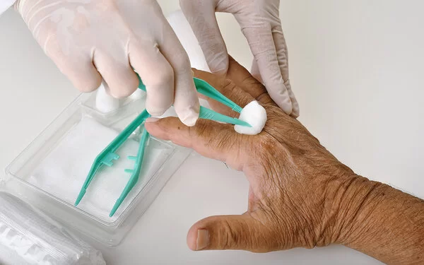 Nahaufnahme. An der braungebrannten Hand eines älteren Menschen wird eine Wunde zwischen Zeige- und Mittelfinger versorgt. Hände in klinischen Gummihandschuhen pressen mit einer grünen Pinzette einen Wattebausch auf die Wunde.