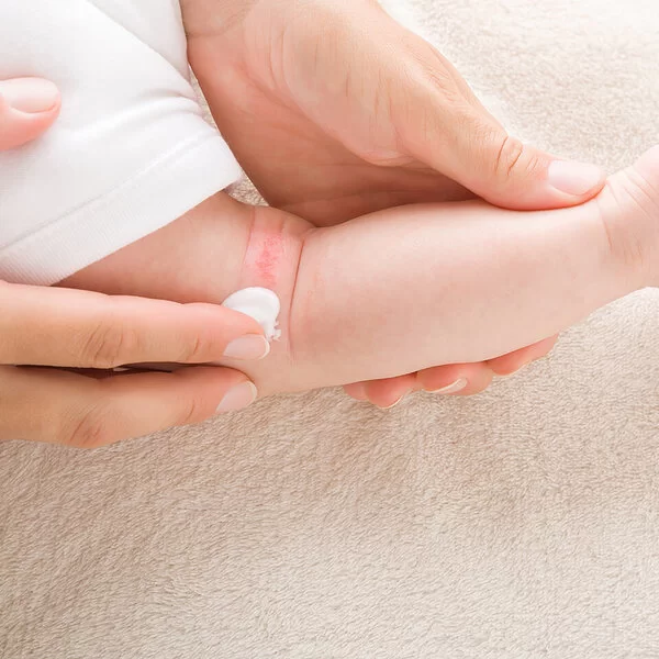 Nahaufnahme. Eine Frauenhand trägt Salbe auf die wunde Kniekehle eines Babys auf. Zu sehen sind nur die Hände und das Bein des Babys von hinten.