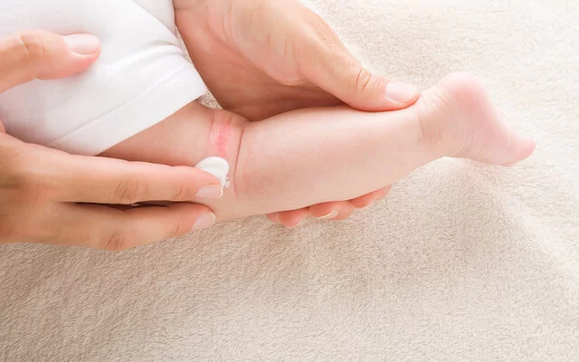 Nahaufnahme. Eine Frauenhand trägt Salbe auf die wunde Kniekehle eines Babys auf. Zu sehen sind nur die Hände und das Bein des Babys von hinten.