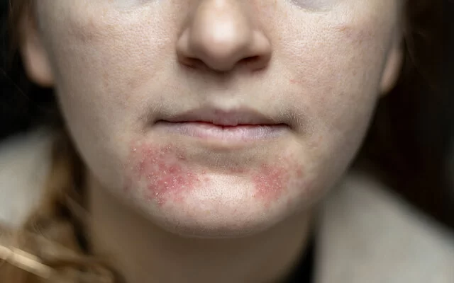 Der untere Gesichtsteil einer Frau ist aus nächster Nähe fotografiert. Zu sehen sind Kinn, Mund, ein Teil der Nase und der Wangen. Unter dem Mund hat die Frau einen roten, teilweise entzündeten Hautausschlag.