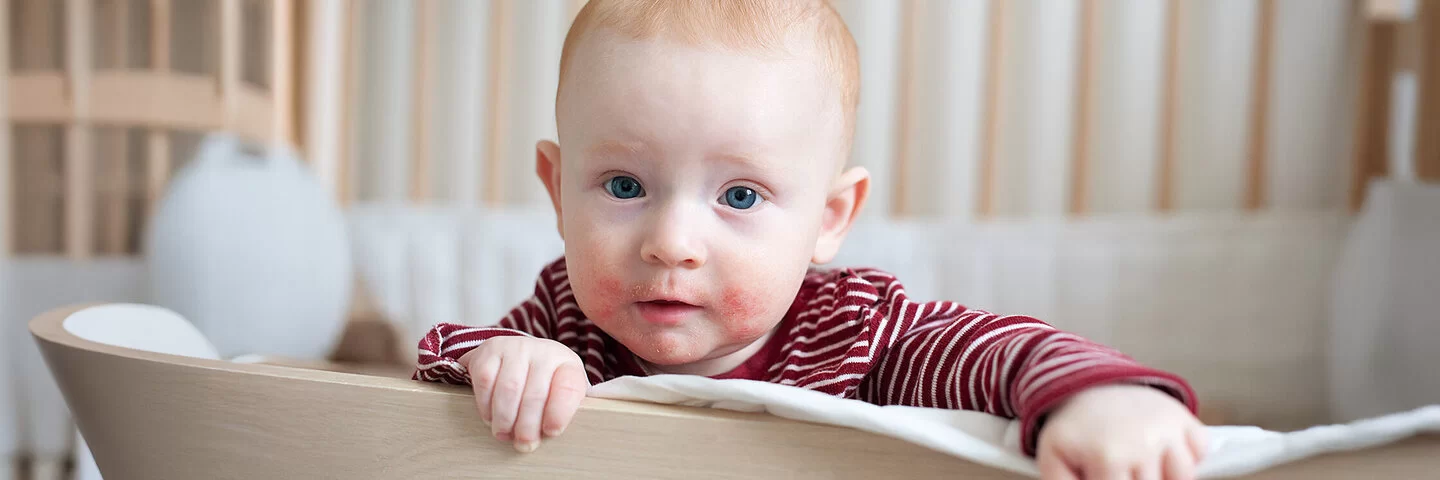 Ein Baby steht im Kinderbett und hält sich am Rand fest. Die Haut um den Mund des Kindes ist rot und schuppig.