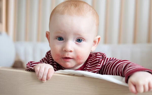 Ein Baby steht im Kinderbett und hält sich am Rand fest. Die Haut um den Mund des Kindes ist rot und schuppig.