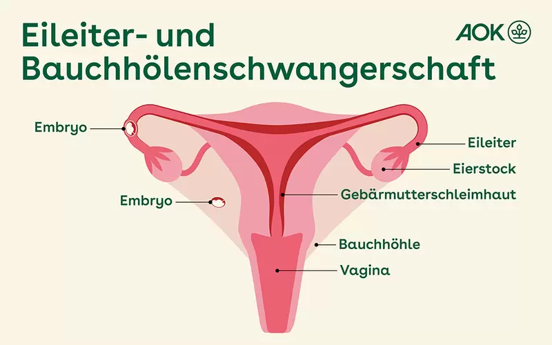 Die Infografik zeigt die Gebärmutter und beide Eileiter der Frau. Dargestellt sind der Fall einer Eileiterschwangerschaft, bei der sich die befruchtete Eizelle in der Eileiter einnistet, als auch der Fall einer Bauchhöhlenschwangerschaft, bei der sich die Eizelle in der Bauchhöhle einnistet.