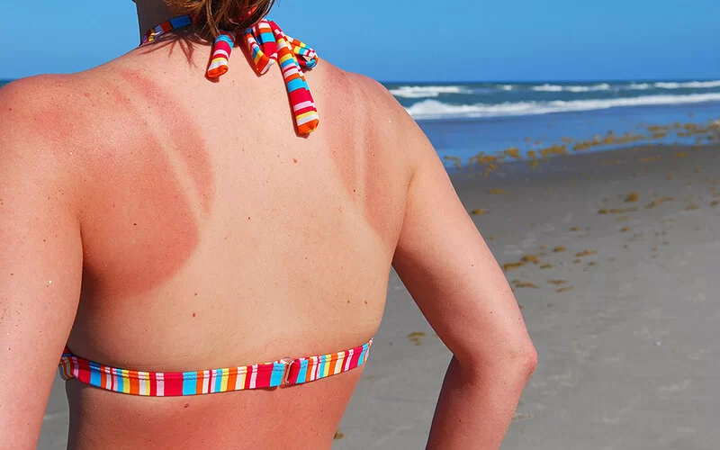 Eine Frau am Strand im Bikini hat von der Sonne verbrannte Schultern.