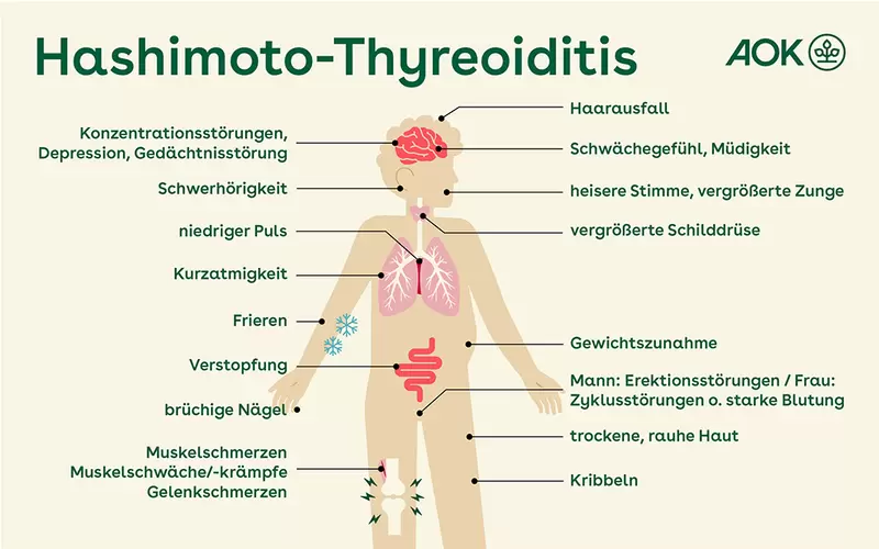 Die Grafik stellt einen menschlichen Körper dar. In einer ergänzenden Beschreibung sind die Krankheiten und Beschwerden dargestellt, die häufig bei einer Hashimoto-Thyreoiditis auftreten.