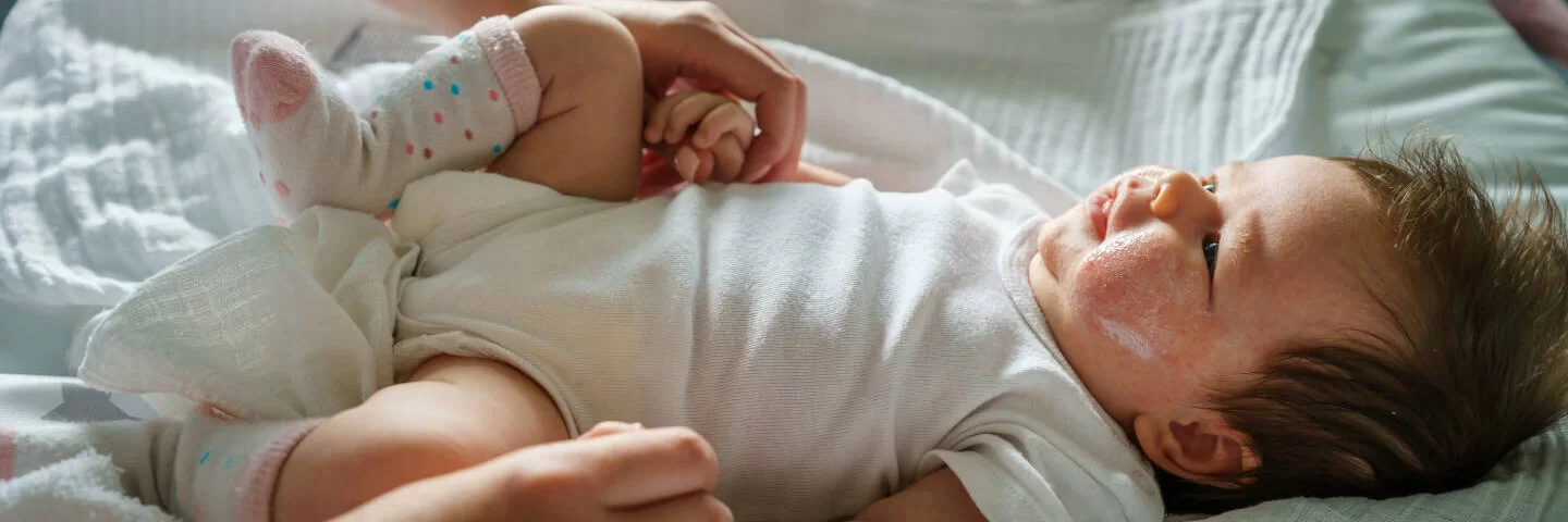 Baby mit Neurodermitis und Wundcreme im Gesicht, das auf einem Wickeltisch liegt.