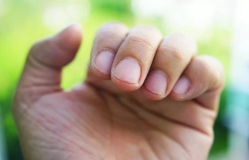 Nahaufnahme einer Hand mit gekrümmten Fingern: Die Nagelhaut der etwas ungepflegten Nägel ist leicht rissig.