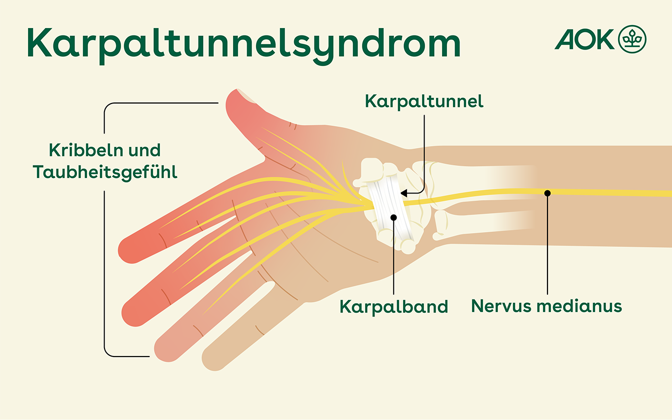 Kann ein Karpaltunnelsyndrom von alleine weggehen?