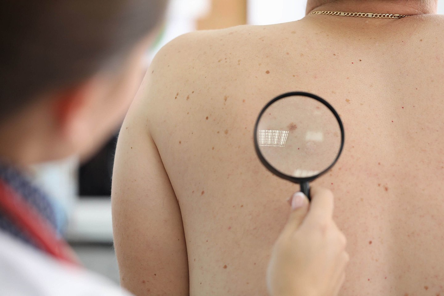 Eine Ärztin führt per Lupe ein Hautkrebsscreening bei einem Patienten durch.