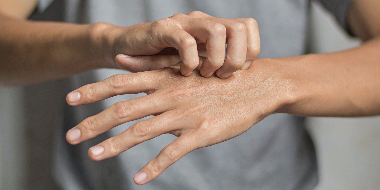 Foto: Nahaufnahme von zwei Händen, die Person kratzt sich einen Handrücken.