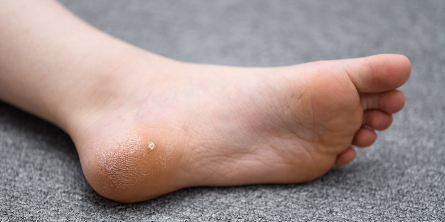Foto: Nahaufnahme eines Fußes mit Warzen an der Ferse.